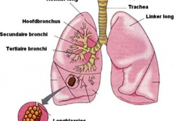 aspiratiepneumonie