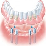 Click Dentures under Anesthesia
