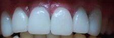 porcelain veneers - after the treatment