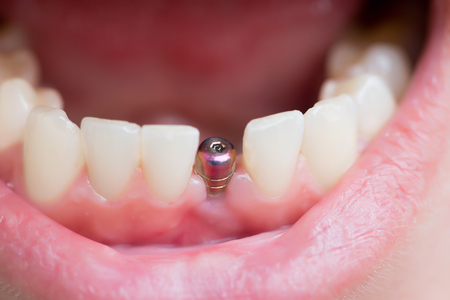 kroon tand implantaat