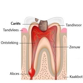 Root canal treatment photo of inflamed molar