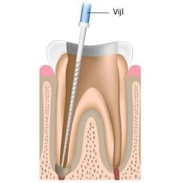 cleaning root canal with file